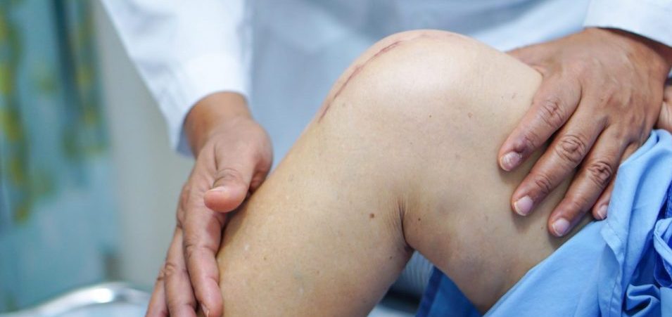 Managing Pain After a Total Knee Replacement